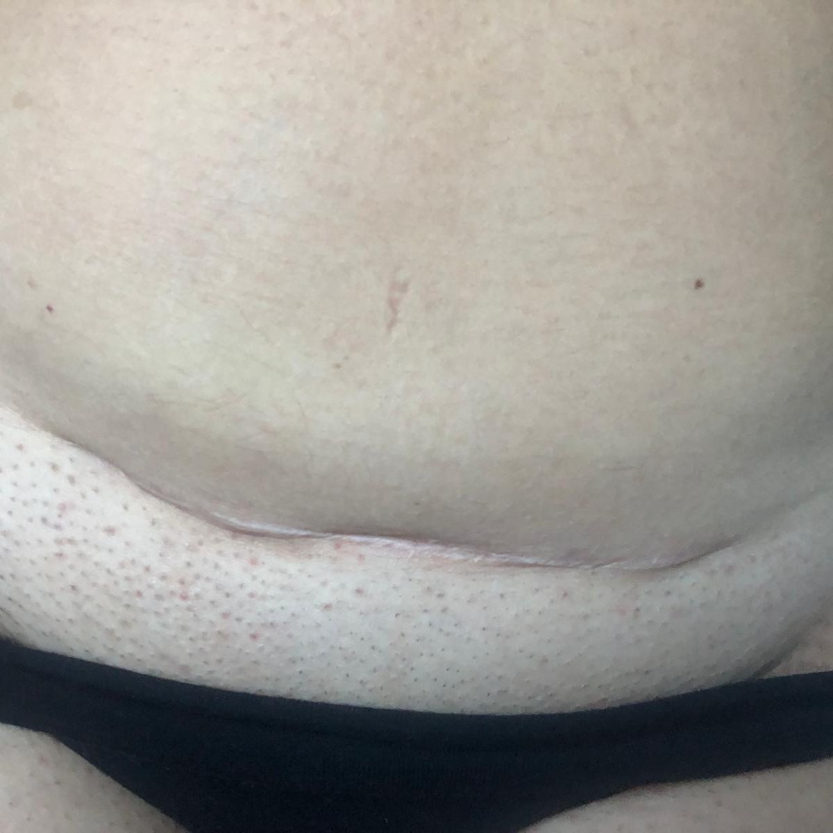 Keizersnede litteken nazorg Almere