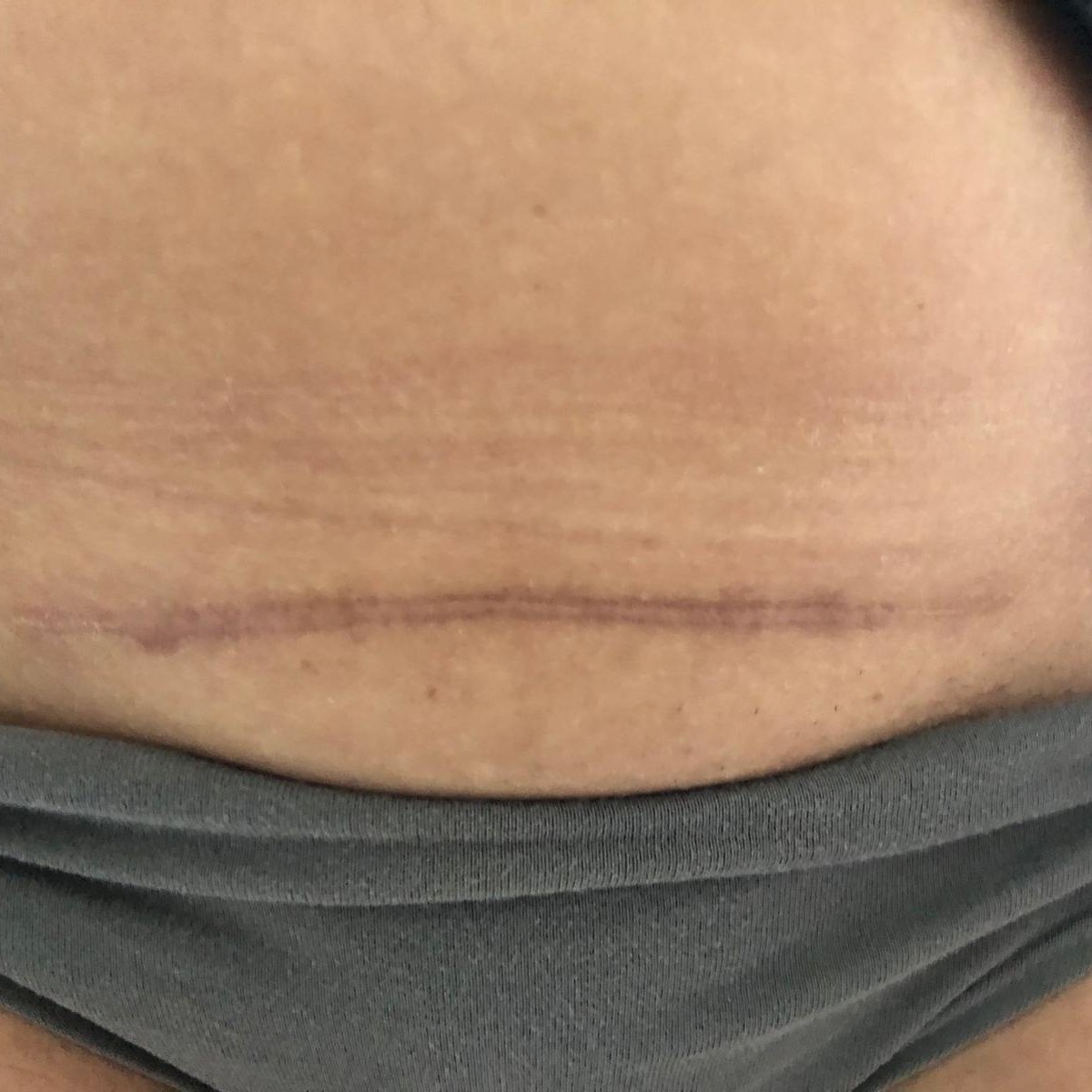 Keizersnede litteken nazorg Almere