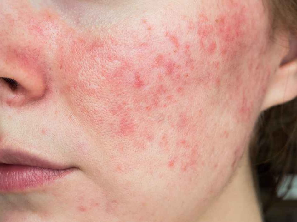 rosacea