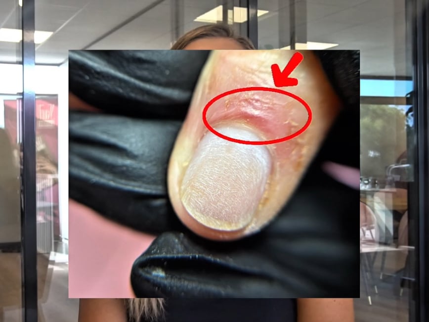 nagelriemen-types-verschillende