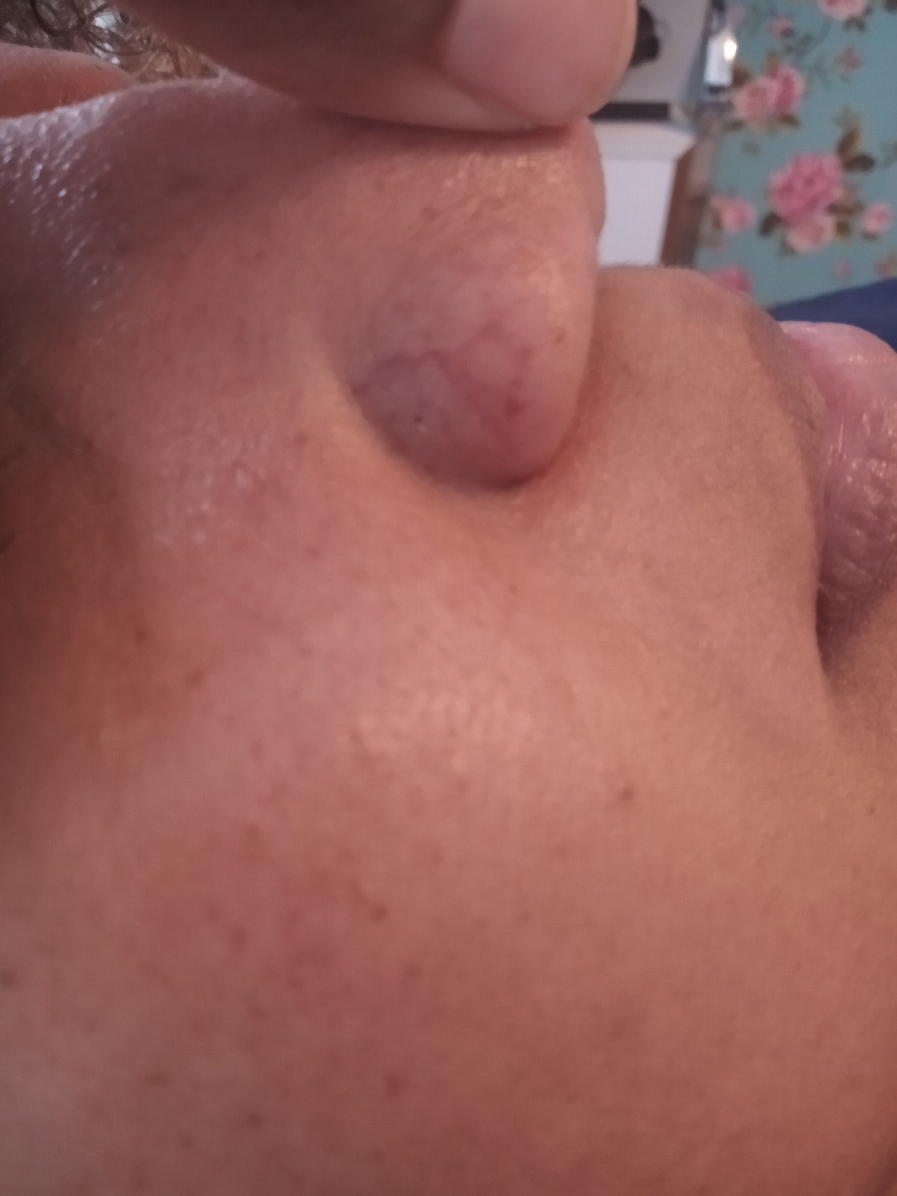 Couperose (verwijde bloedvaatjes in het gezicht) komt in de getinte huid ook voor. Behandelen is mogelijk. Getinte huid? Couperose gezicht? Boek vandaag afspraak voor intakegesprek + behandeling - Huidtherapie donkere huid MellaCare Rotterdam.