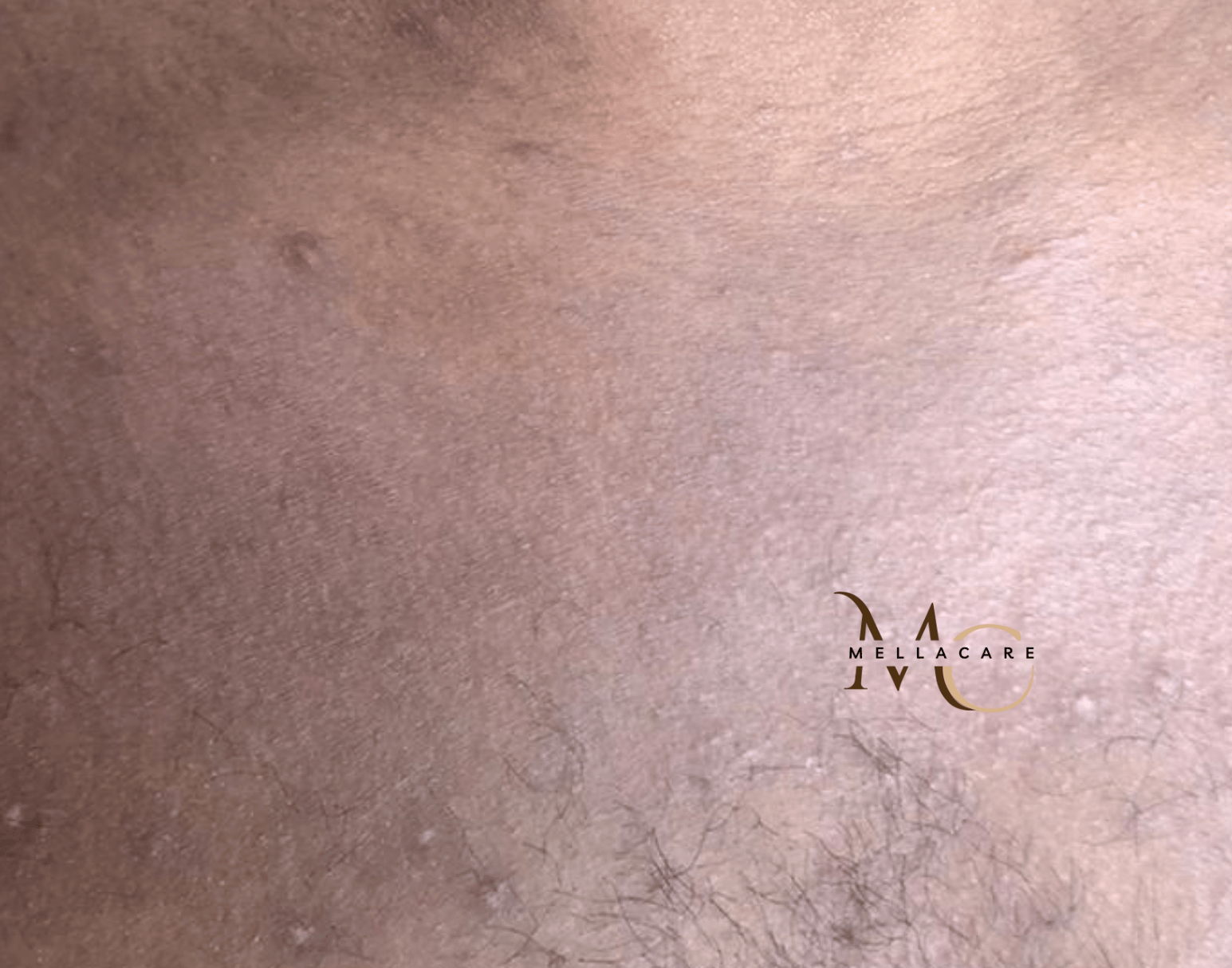 Bij langdurige dehydratatie in de gekleurde huid, kan de huid lokaal verkleuren. De huid regelmatig hydrateren verminderd huidirritatie. Huid- en productadvies nodig? Boek intakegesprek bij MellaCare Rotterdam