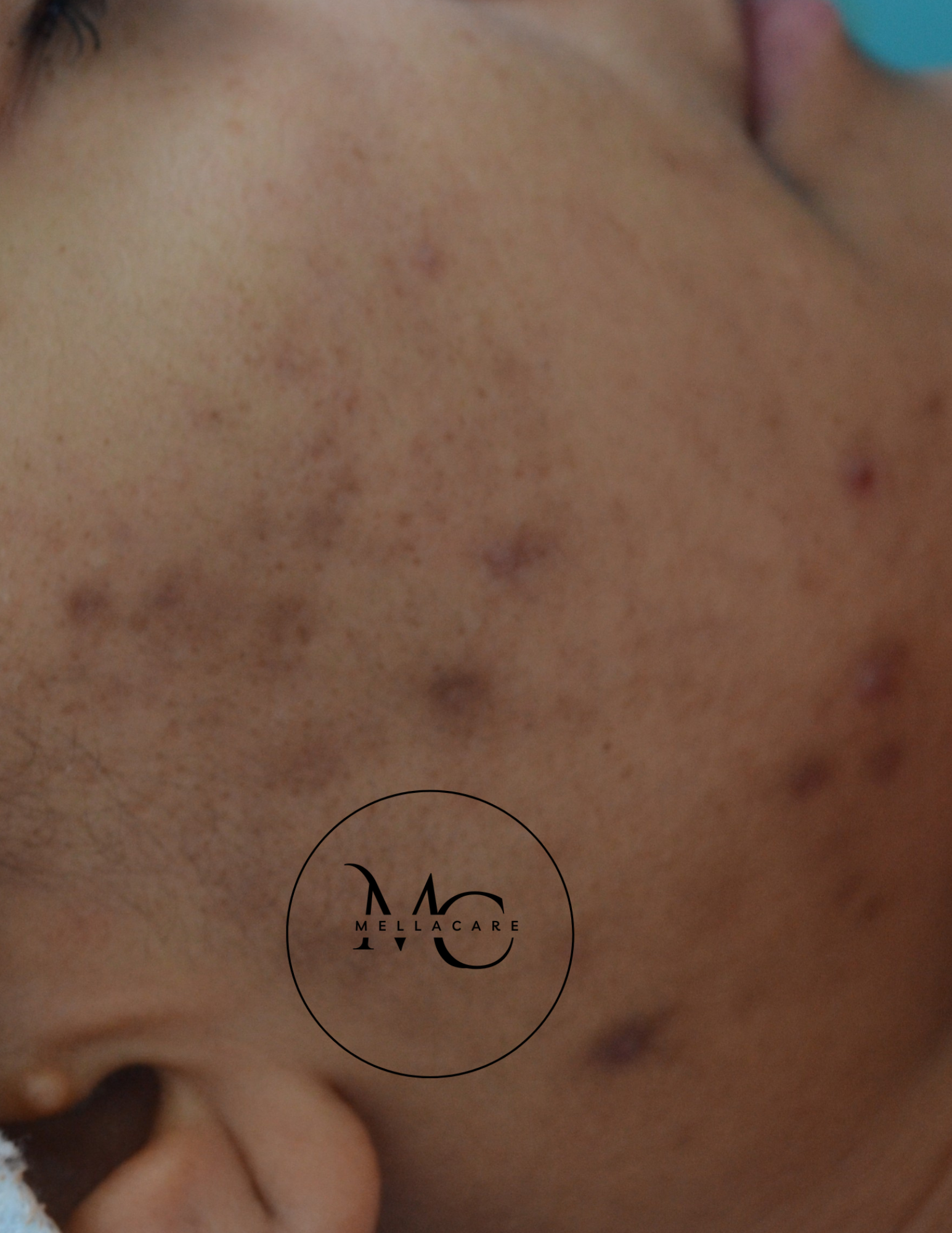 Pigmentvlekken kent verschillende oorzaken. Acne kan in de bruine huid donkere pigmentvlekken achterlaten. Weten hoe pigmentvlekken te genezen? Boek intakegesprek + behandeling bij MellaCare Rotterdam.