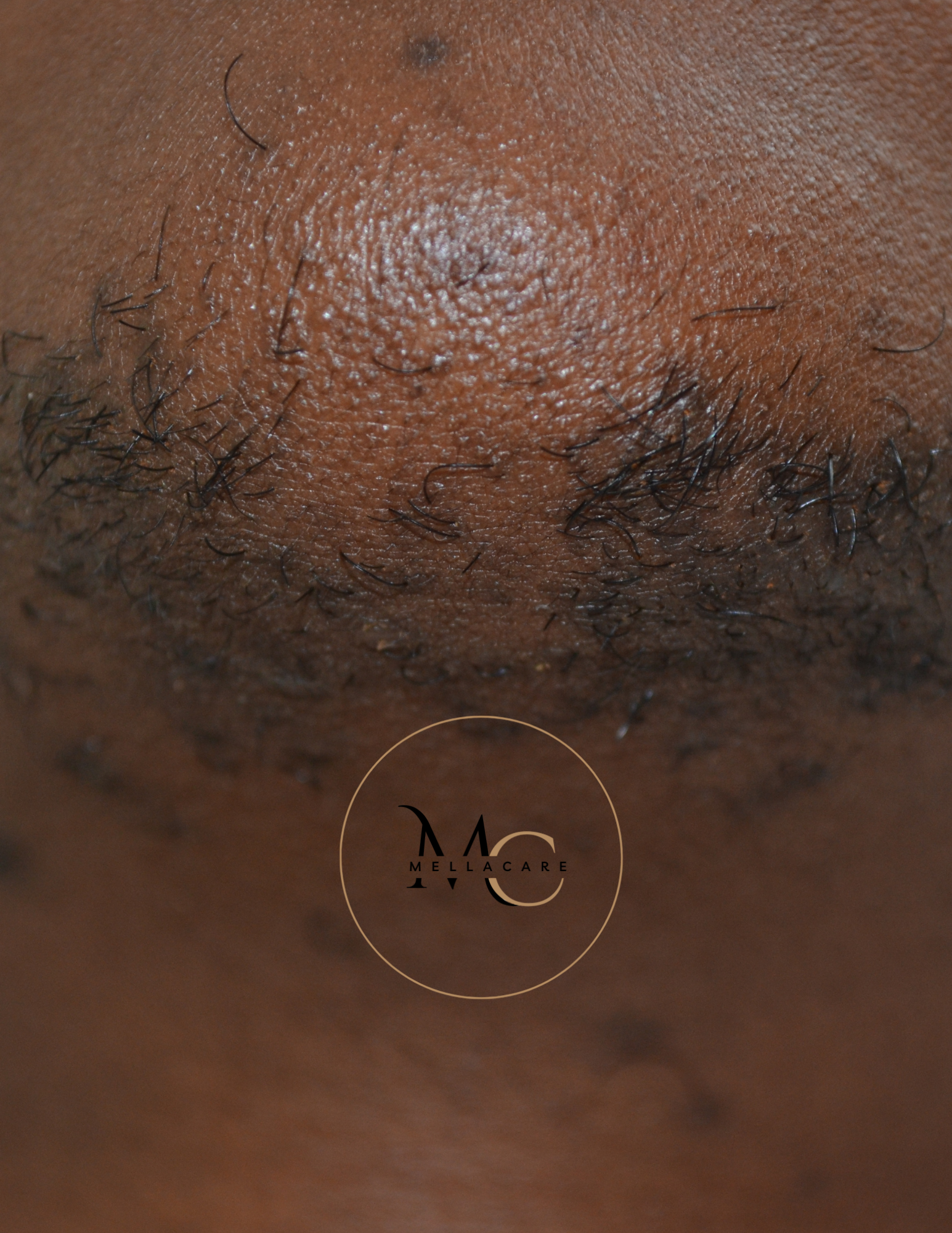 Ongewenste haargroei op kin, hals of bovenlip? Dit kan je zelfvertrouwen beïnvloeden. Ontdek de professionele en langdurige ontharingsbehandelingen bij huidtherapie MellaCare in Rotterdam. Boek je intake vandaag nog!