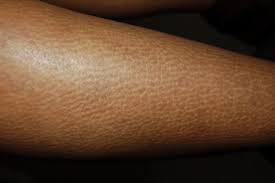 Langdurig vocht tekort? Te weinig waterdrinken. Je huid niet wekelijks insmeren met de juiste bodylotion of body butter (geen vaseline of paraffine), kunnen scheurtjes in de huid ontstaan. Huidadvies nodig? Boek intakegesprek MellaCare Rotterdam.