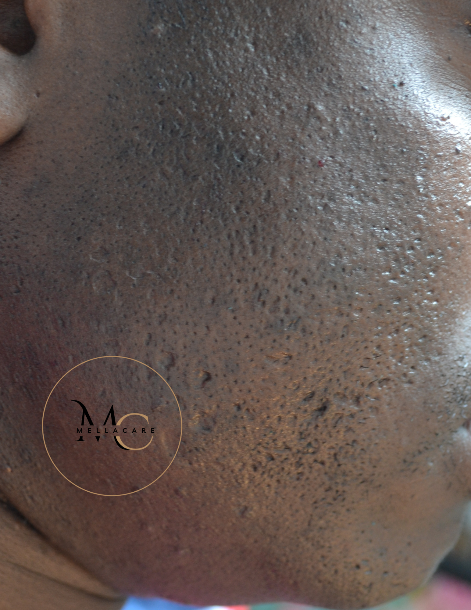 Combinatie van acne littekens en littekens van ingegroeide baardharen bij donkere man uit de Afrikaanse diaspora. Boek een intakegesprek + littekenbehandeling bij MellaCare Rotterdam.